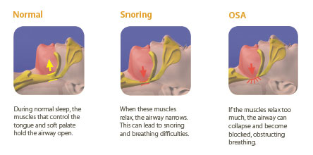 How Obstructive Sleep Apnoea occurs 