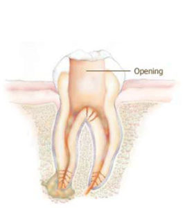 Root Canal Treatment - Step 1