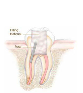 Root Canal Treatment - Step 4