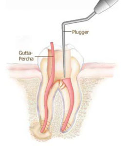 Root Canal Treatment - Step 3