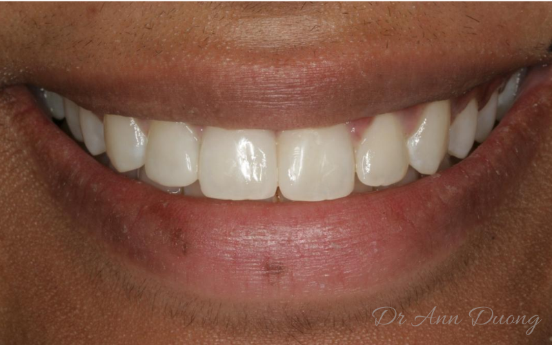 "Barrel-shaped" incisors after dental bonding