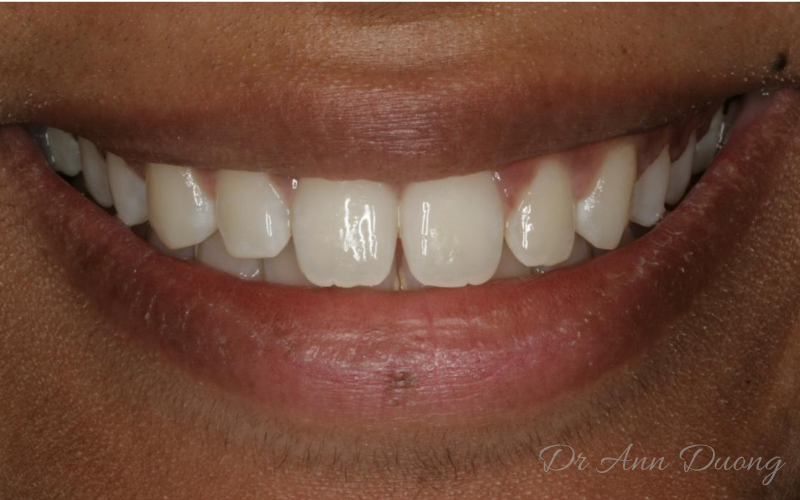 "Barrel-shaped" incisors before dentalbonding