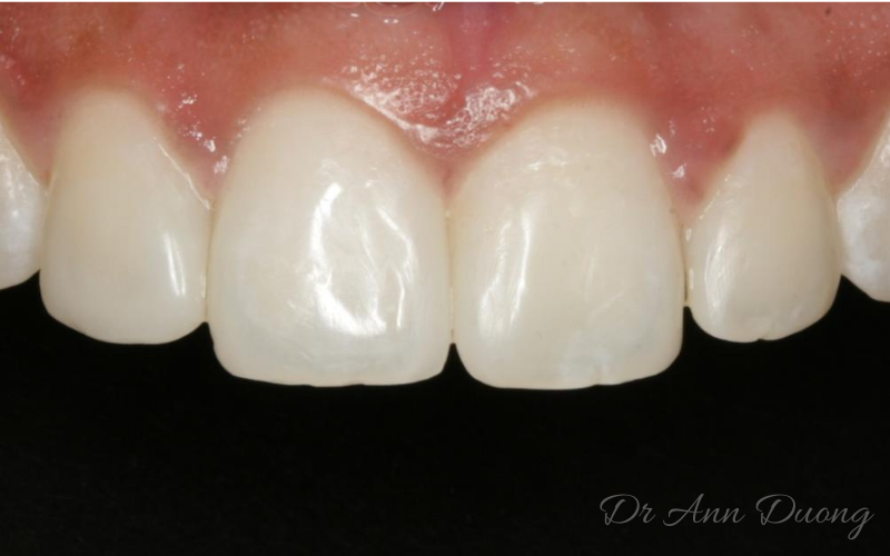 After dental bonding, Natalie's teeth have a more natural shape.