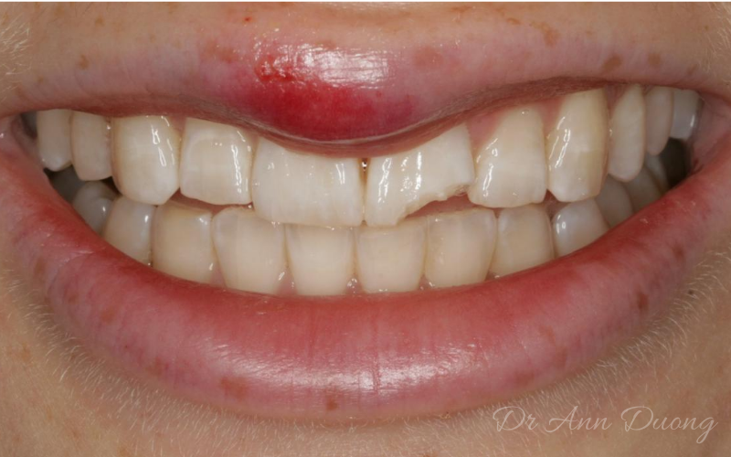 Case study showing a fractured upper incisor before dental bonding