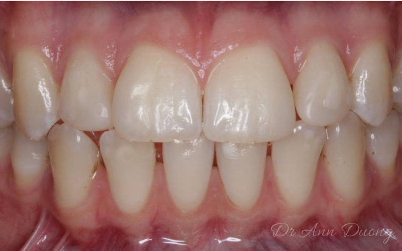 After dental bonding, the diastema (gap) has been closed (front view)