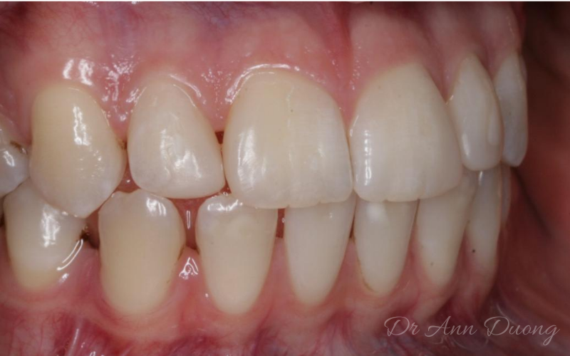 After dental bonding, the diastema (gap) has been closed (side view)