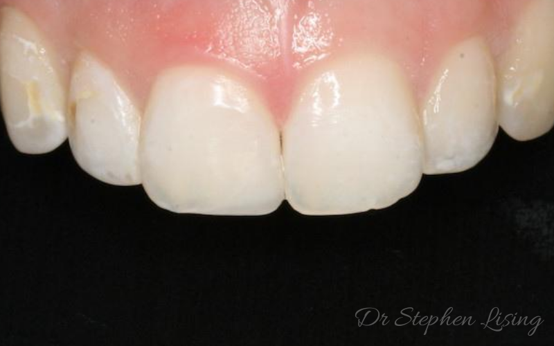 Fractured central incisor after it was repaired with dental bonding