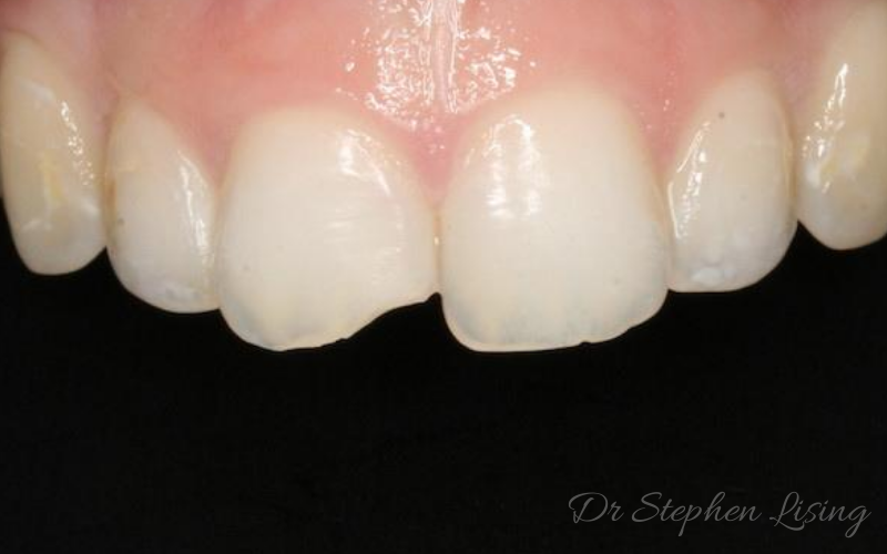 Fractured central incisor before it was repaired with dental bonding