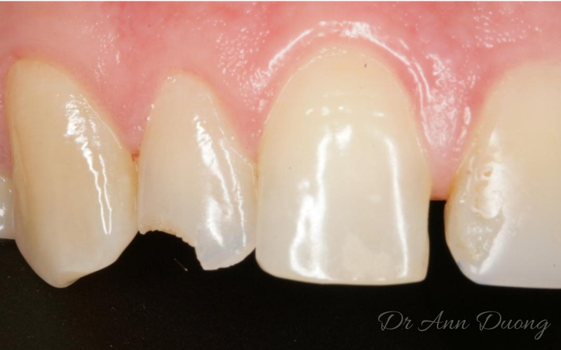Fractured lateral incisor before dental bonding