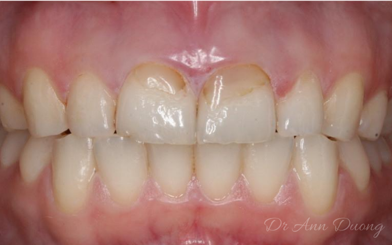 Old composite resin fillings on front teeth are stained and yellow
