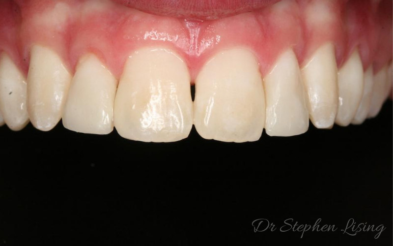 The malformed lateral incisors were rebuilt using dental bonding