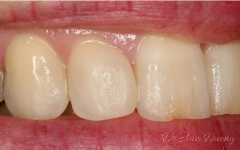 After dental bonding the lateral incisor has been widened to close the gap