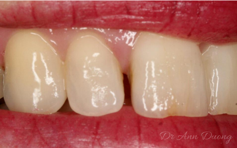 Gap between central and lateral incisor before dental bonding