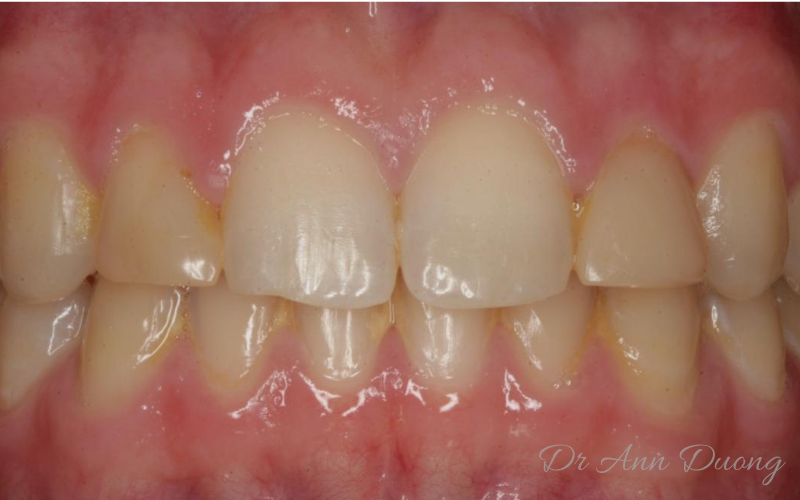 Peter's teeth and old composite resin filling were yellowing