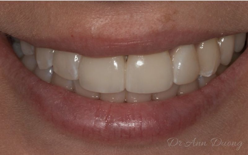 The veneers are tried in after an adjustment. The outer corner of the left central incisor has been rounded.