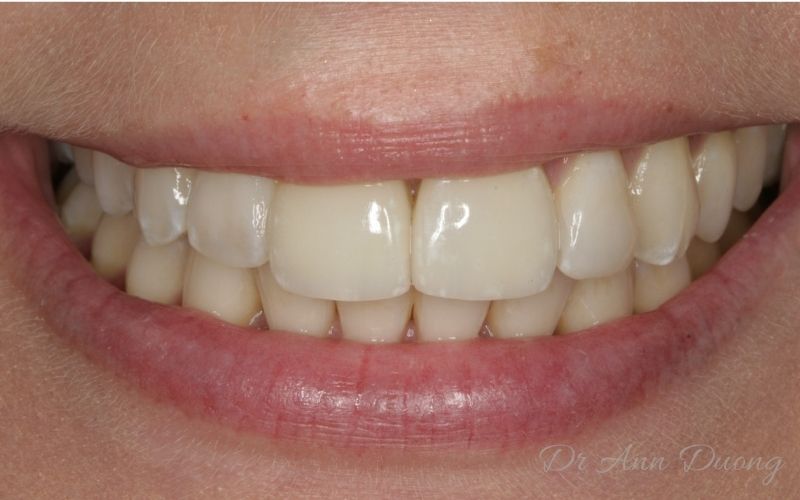 Veneers Case After Treatment. More white flecks have been added at the dental laboratory to better match the natural teeth.