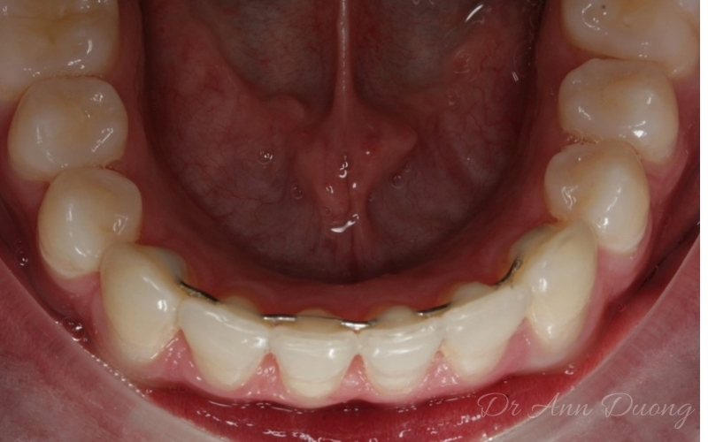 Invisalign Teeth Straightening - Correct Crowded Lower Incisors - After