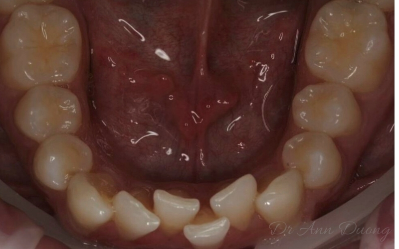 Invisalign Teeth Straightening - Correct Crowded Lower Incisors - Before