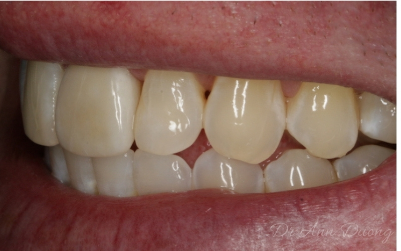 Invisalign Teeth Straightening - Correct Protrusive Incisor - After