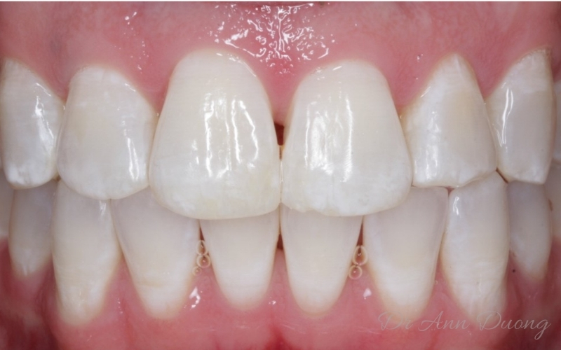 Invisalign Teeth Straightening - Incisor Crossbite - After