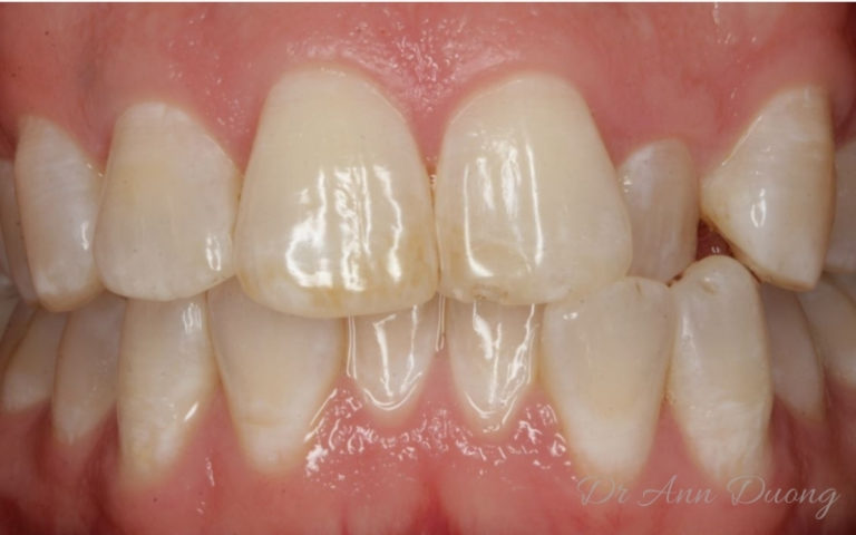 Invisalign Before and After - Case Studies by Preventive Dentistry, Braddon