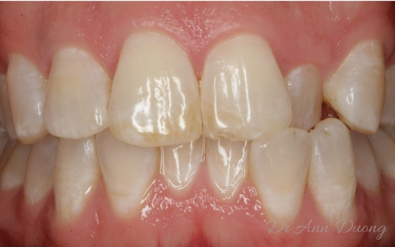 Invisalign Teeth Straightening - Incisor Crossbite - Before