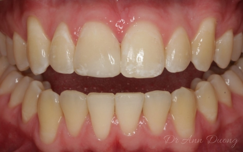 Repair of a fractured incisor - After
