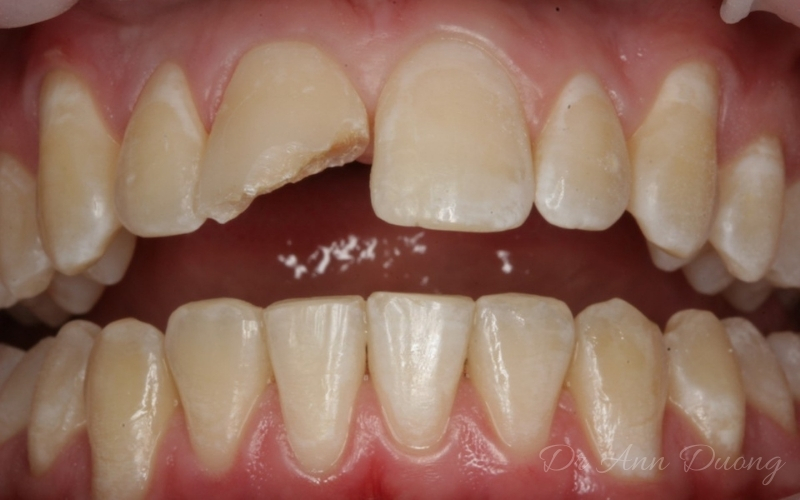 Repair of a fractured incisor - Before