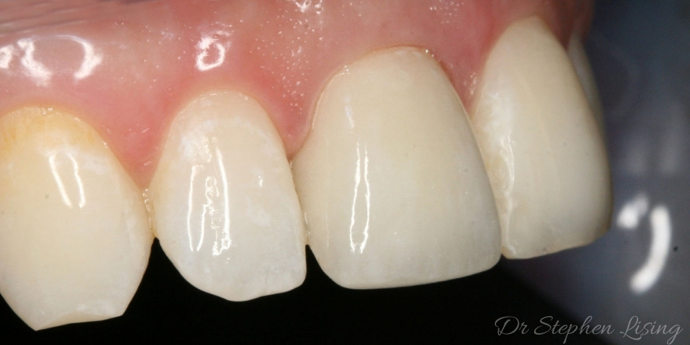 The new crown placed by Dr Stephen Lising looks natural, thanks to modern ceramic materials and techniques
