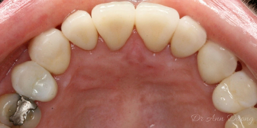 Eight ceramic crowns now protect Lauren's teeth from further wear