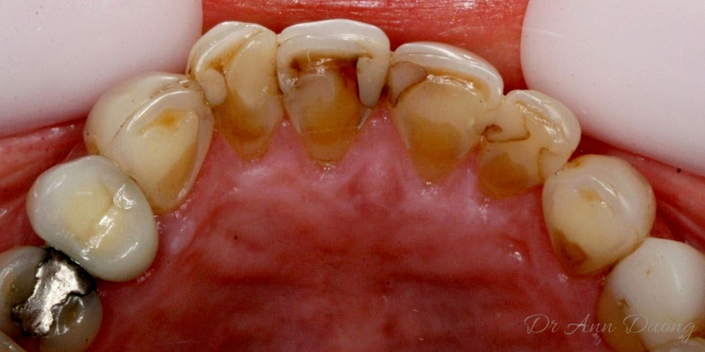 Before ceramic crowns, Lauren's teeth had become very worn