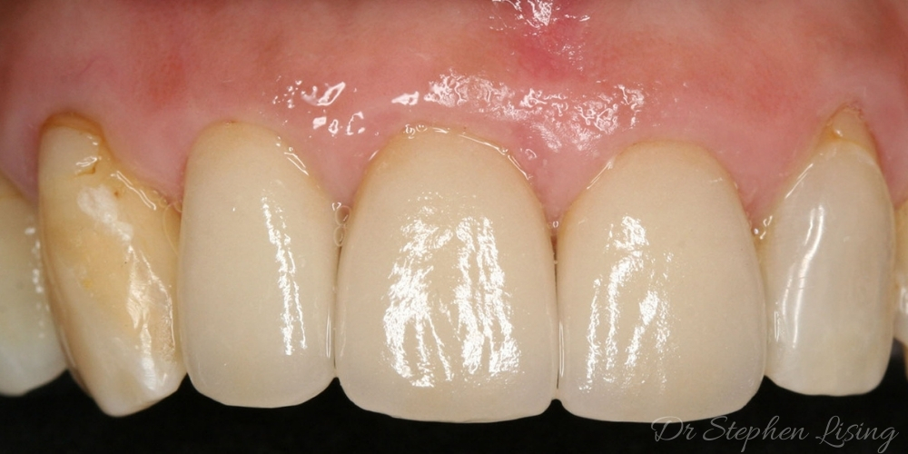 After three new ceramic crowns were placed, Mei Ling's teeth look natural