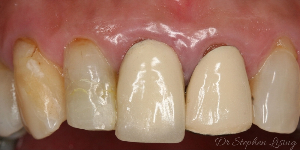 Mei Ling's old crowns and fillings did not look natural