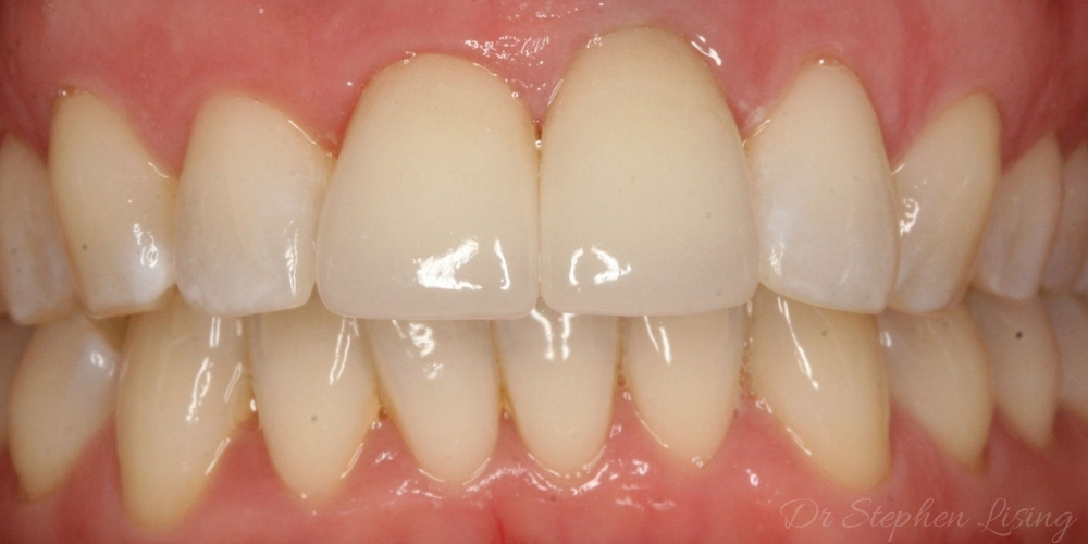Natalie's teeth with two beautiful ceramic crowns