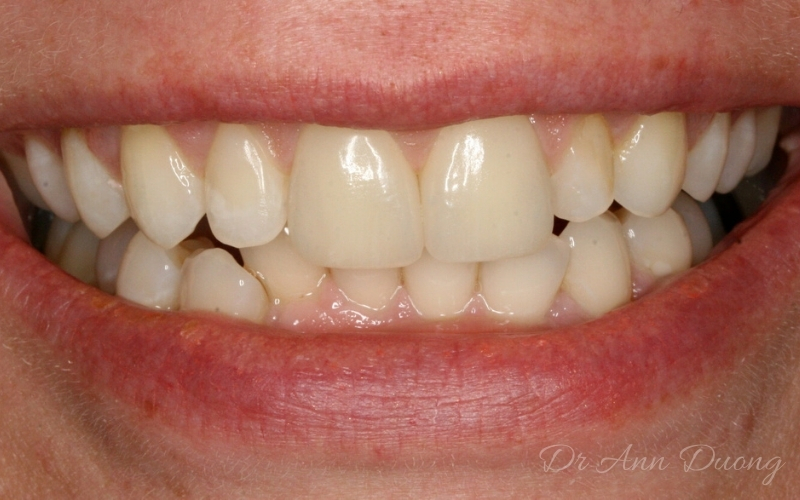 After porcelain veneers were placed on the two central incisors