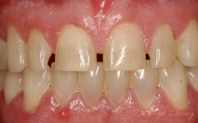 Before porcelain veneers, these teeth looked small and short