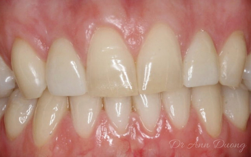 After porcelain veneers are placed on the two lateral incisors