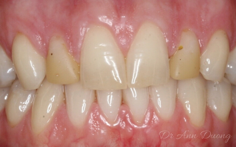 After porcelain veneers on both lateral incisors