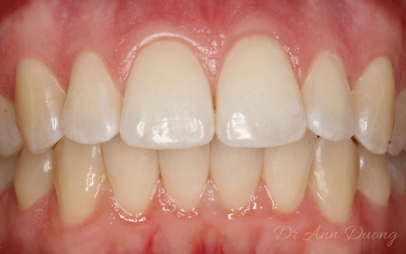 Coco's straightened teeth after a short course of Invisalign treatment