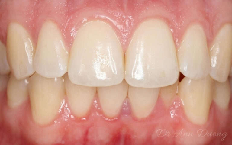 Dogs with braces image