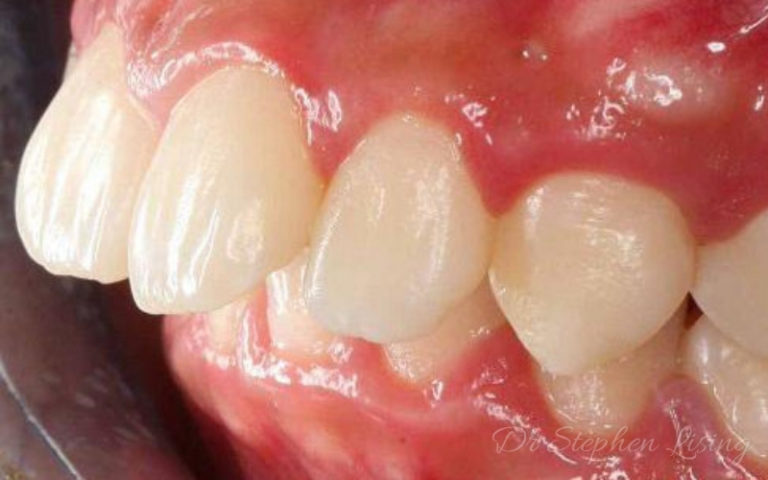 Invisalign storage case picture