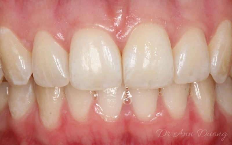 After Invisalign, Katherine's front teeth are properly aligned
