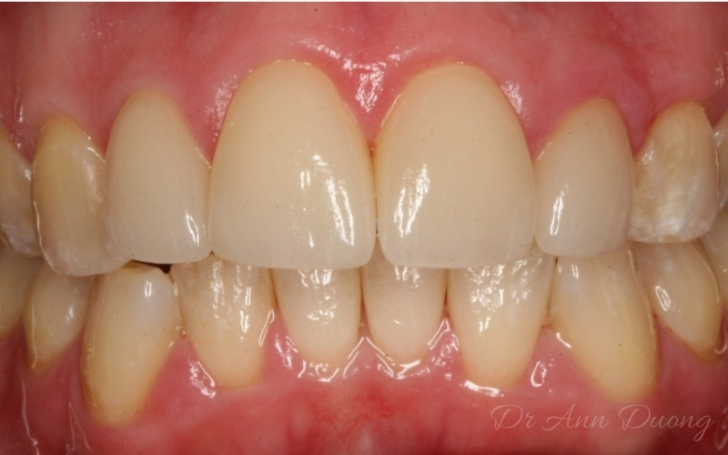 After four porcelain veneers were placed on the front teeth