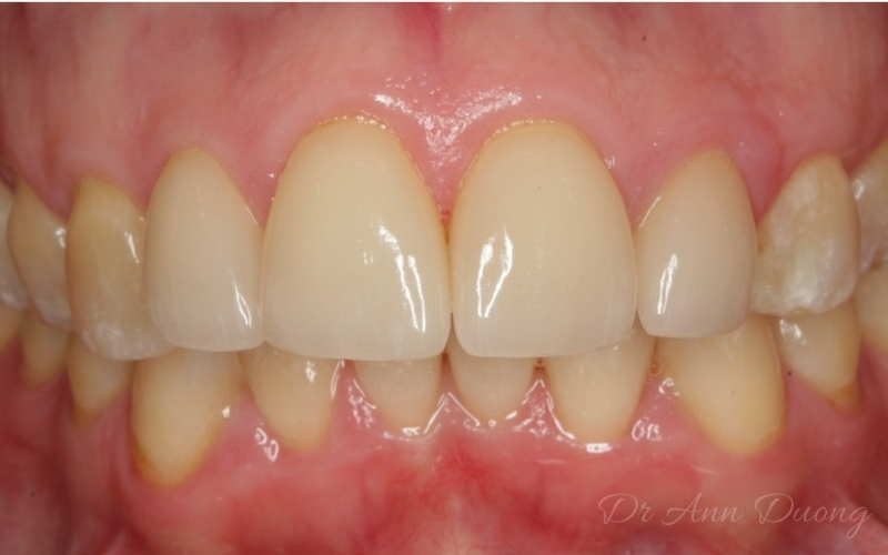 Nine years after four porcelain veneers were placed