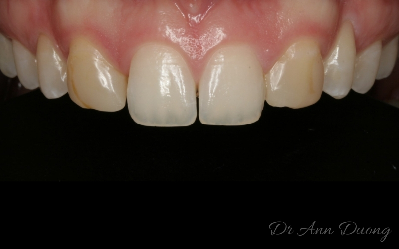 Missing lateral incisors - before porcelain veneers
