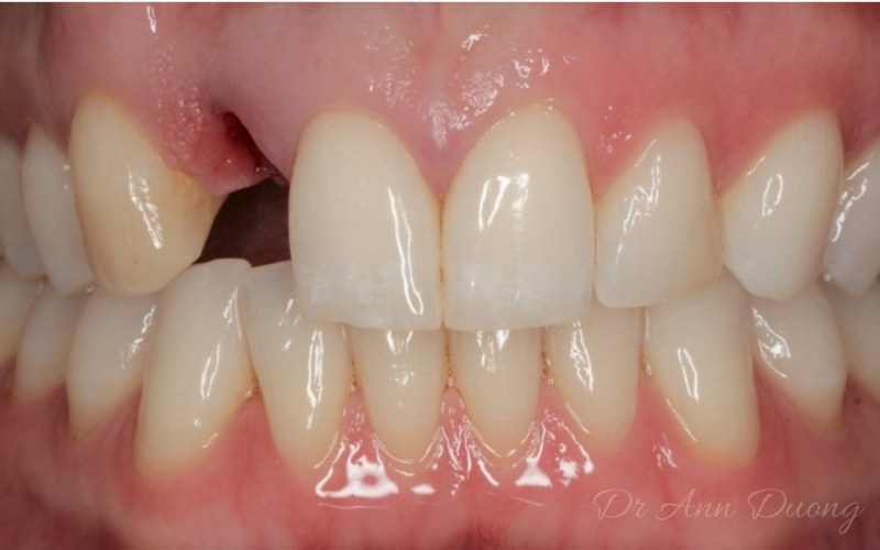 Bonded bridge case study showing Rachel immediately after removal of her baby incisor