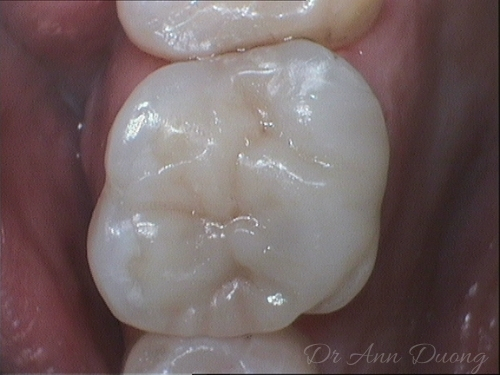 The same molar after an onlay has been placed