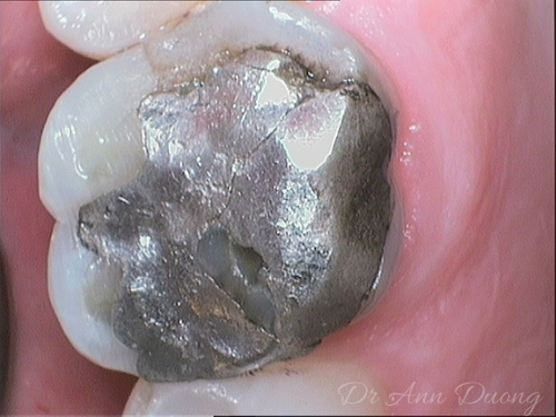 Close up of a molar tooth showing a cracked, large amalgam filling
