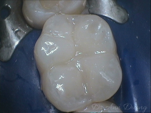 A new composite resin filling has been placed. It blends in beautifully with the natural teeth