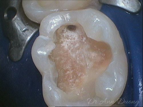 This molar tooth has just had an old filling removed. A blue rubber dam is in place